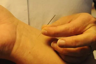 Acupuncture : la thérapie des aiguilles