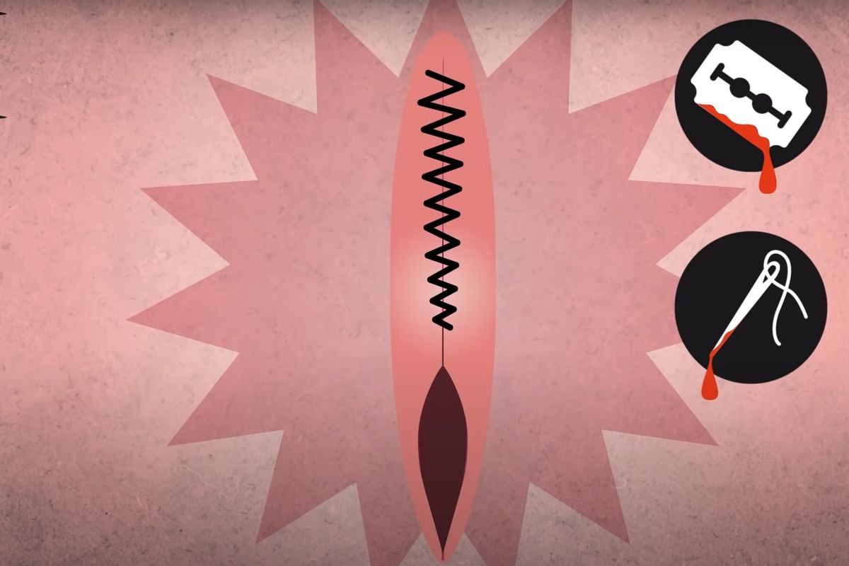 Excision, et cætera : 