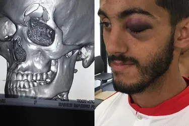 ASM : Jaoudat défiguré lors d'un match avec le Maroc